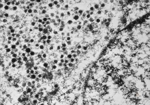 F, 71y. | Merkel cell tumor F, 71y. | Merkel cell tumor